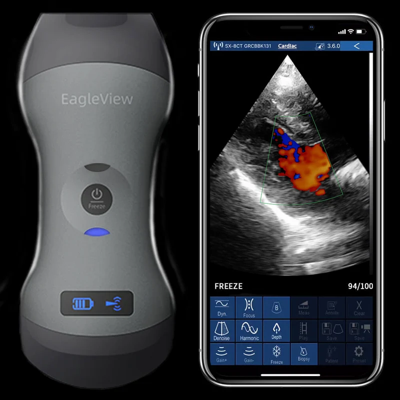 Scanner à ultrasons de type sonde sans fil EagleView™
