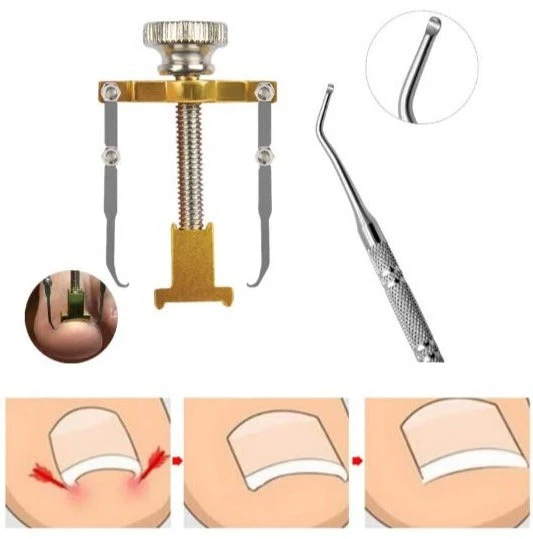 Kit Correcteur Réparateur d'Ongles Incarnés + Tige de Pédicure